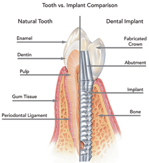 dental-implant